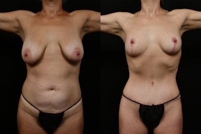 Tummy Tuck Before & After Gallery - Patient 262346 - Image 1