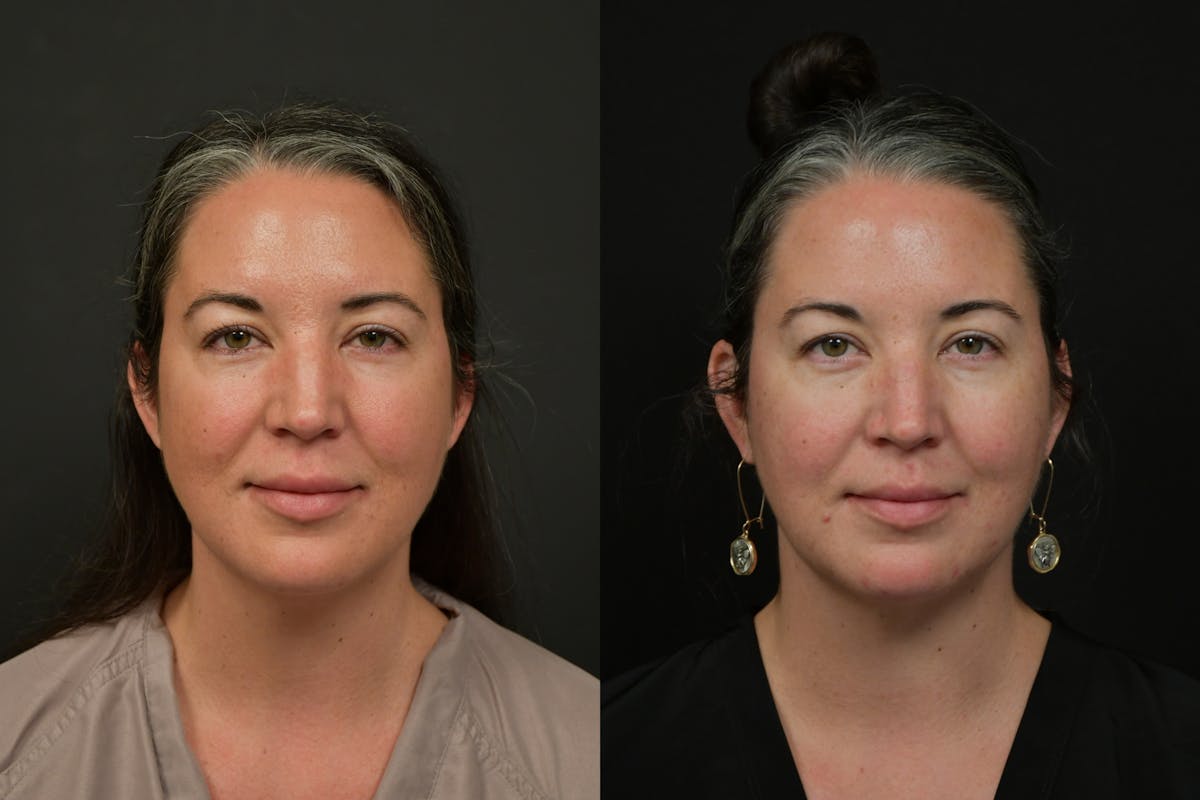 Chin Augmentation Before & After Gallery - Patient 401598 - Image 3