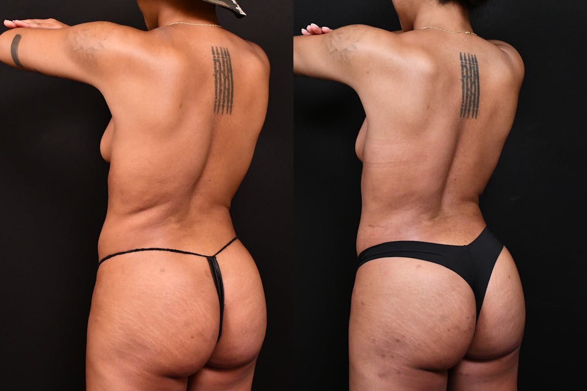 Liposuction / BodyTite Before & After Gallery - Patient 113114 - Image 6
