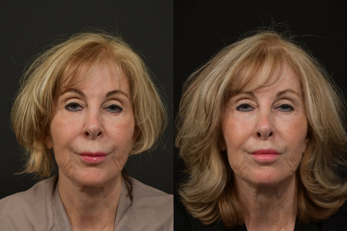 Lip Lift Before & After Gallery - Patient 256172 - Image 1