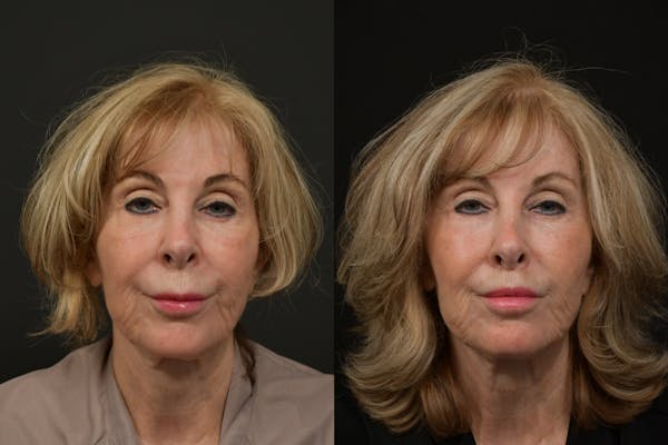 Lip Lift Before & After Gallery - Patient 256172 - Image 1