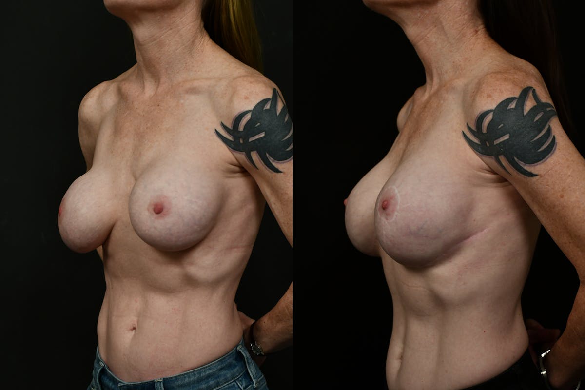 Breast Lift Before & After Gallery - Patient 829900 - Image 2