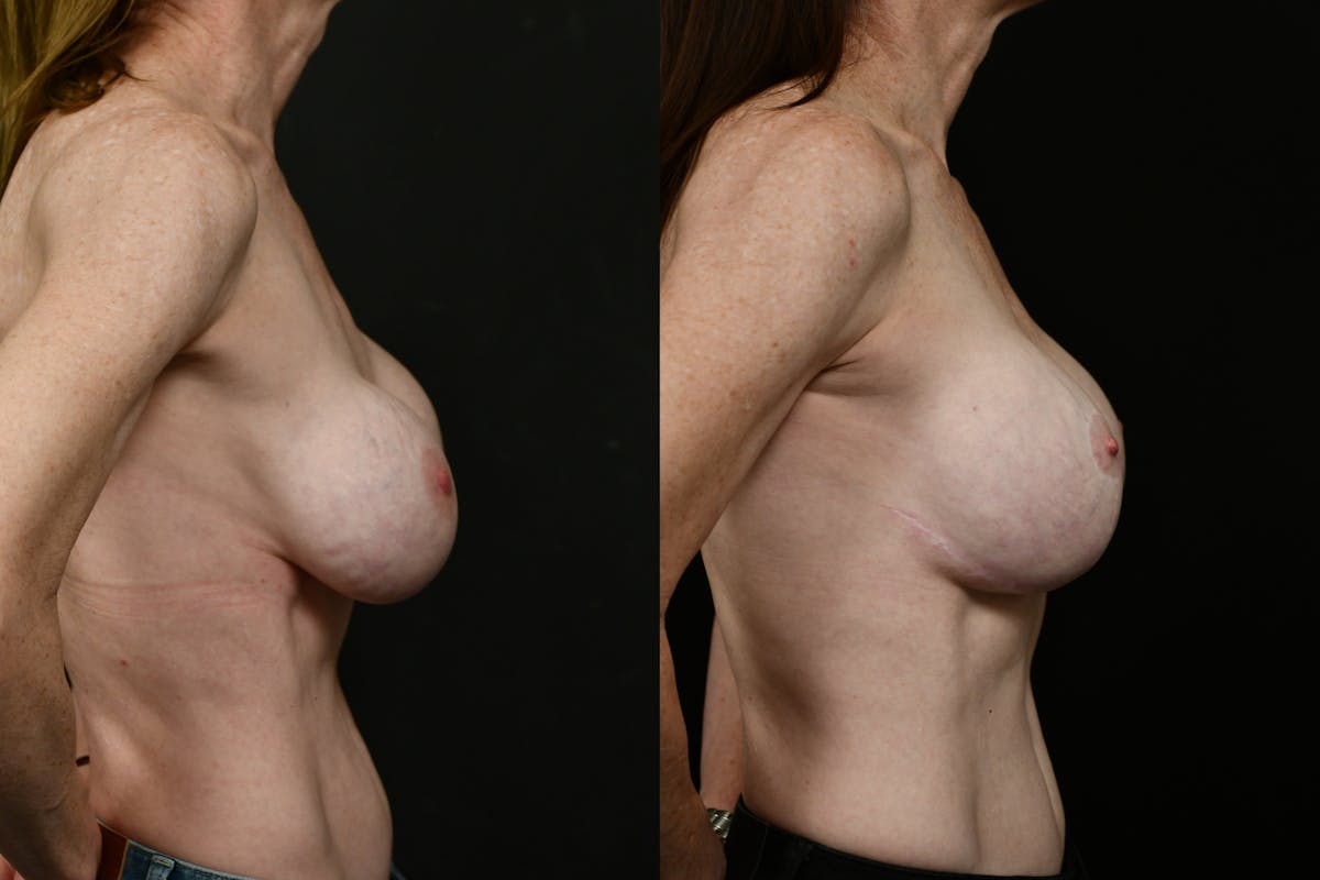 Breast Lift Before & After Gallery - Patient 829900 - Image 5