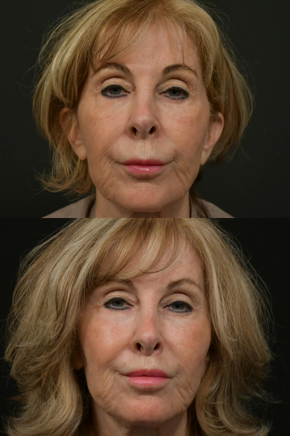 Lip Lift Before & After Gallery - Patient 256172 - Image 6