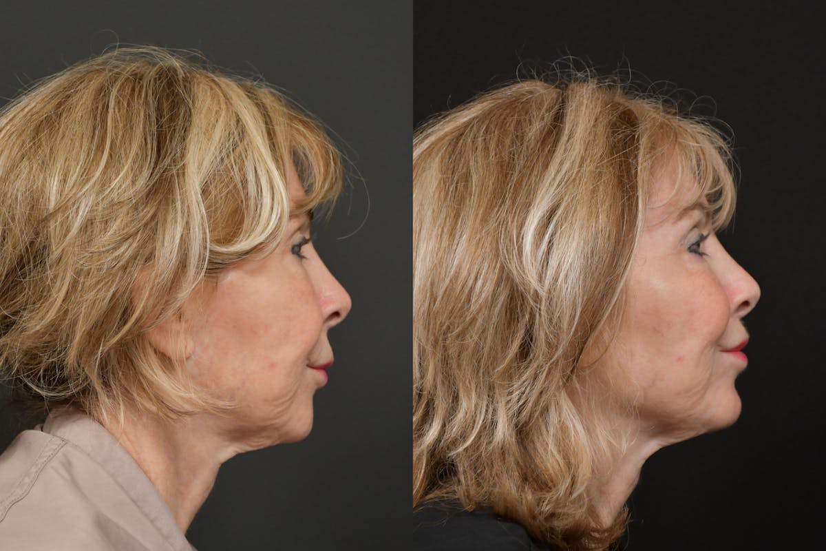 Lip Lift Before & After Gallery - Patient 256172 - Image 3
