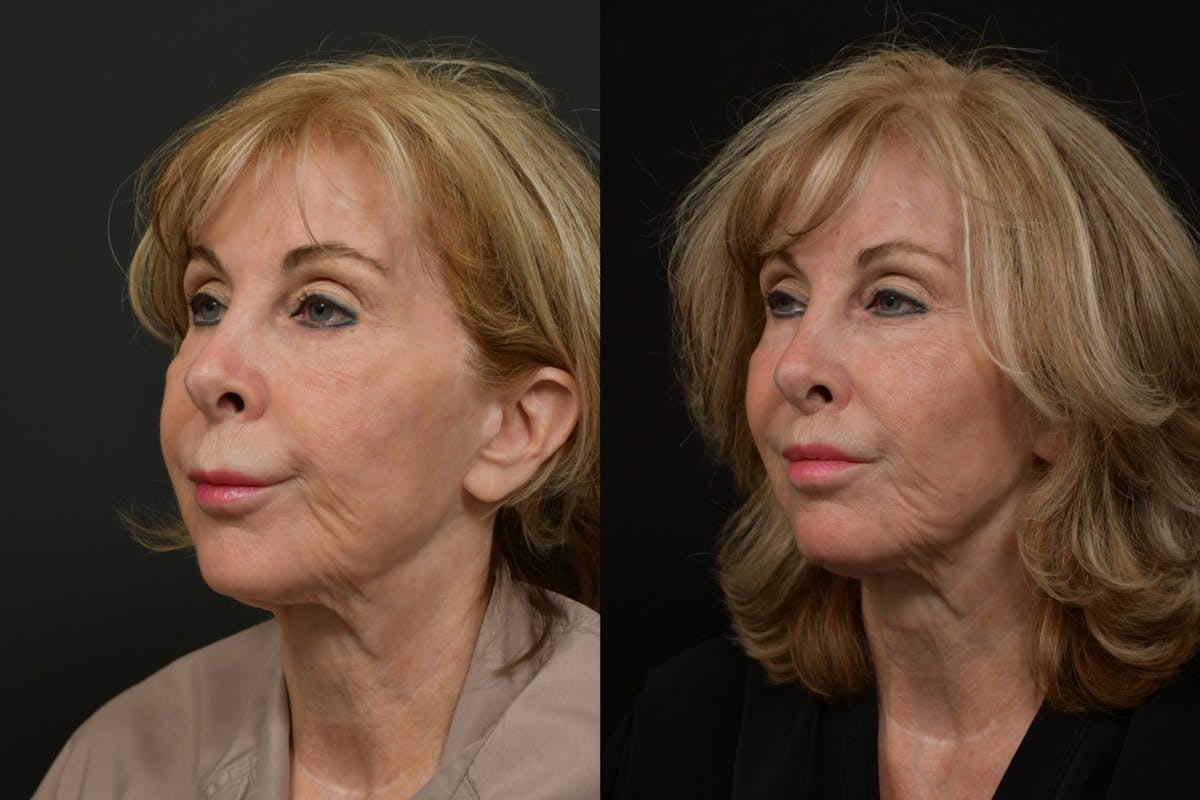 Lip Lift Before & After Gallery - Patient 256172 - Image 4