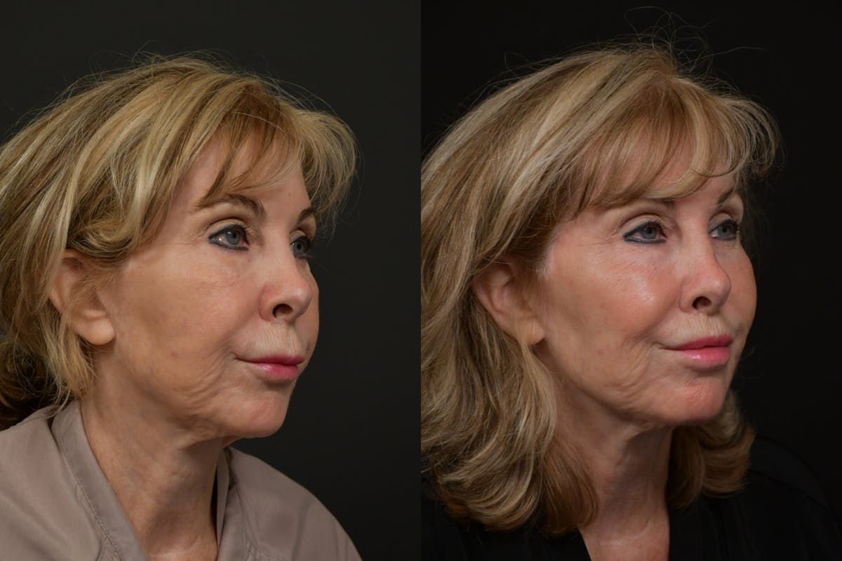 Lip Lift Before & After Gallery - Patient 256172 - Image 2