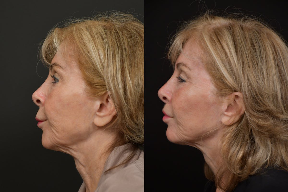 Lip Lift Before & After Gallery - Patient 256172 - Image 5