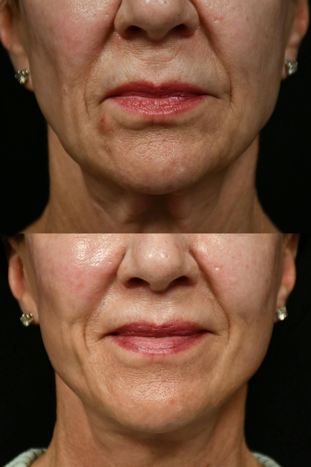 Lip Lift Before & After Gallery - Patient 834185 - Image 7