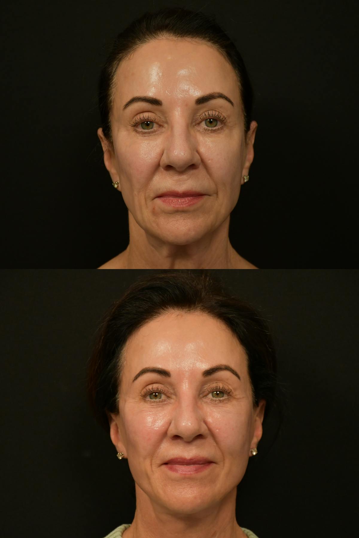 Lip Lift Before & After Gallery - Patient 834185 - Image 6