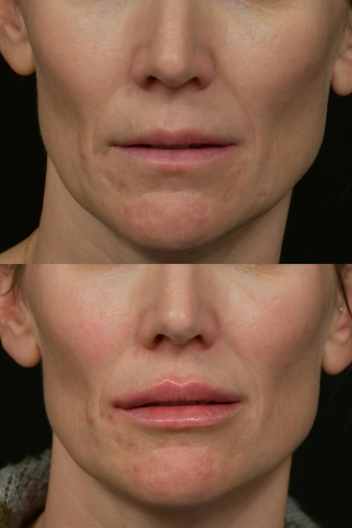Injectables Before & After Gallery - Patient 177889 - Image 2