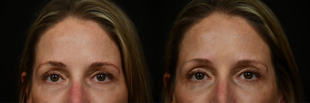 Brows and Lashes Before & After Gallery - Patient 259504 - Image 2
