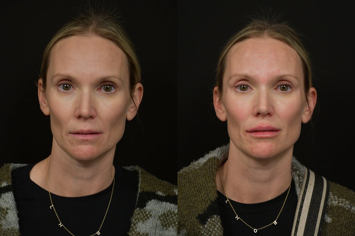 Injectables Before & After Gallery - Patient 177889 - Image 1