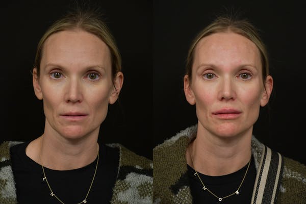 Injectables Before & After Gallery - Patient 177889 - Image 1