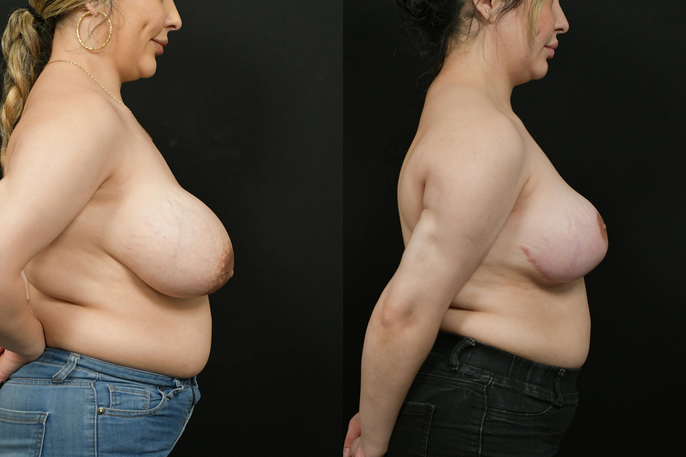 Breast Reduction Before & After Gallery - Patient 156608 - Image 3