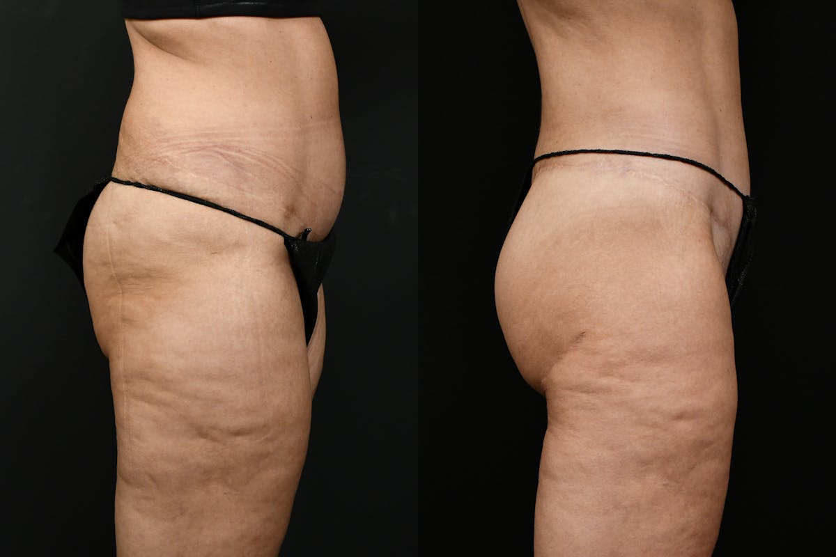 Butt Augmentation Before & After Gallery - Patient 251812 - Image 3