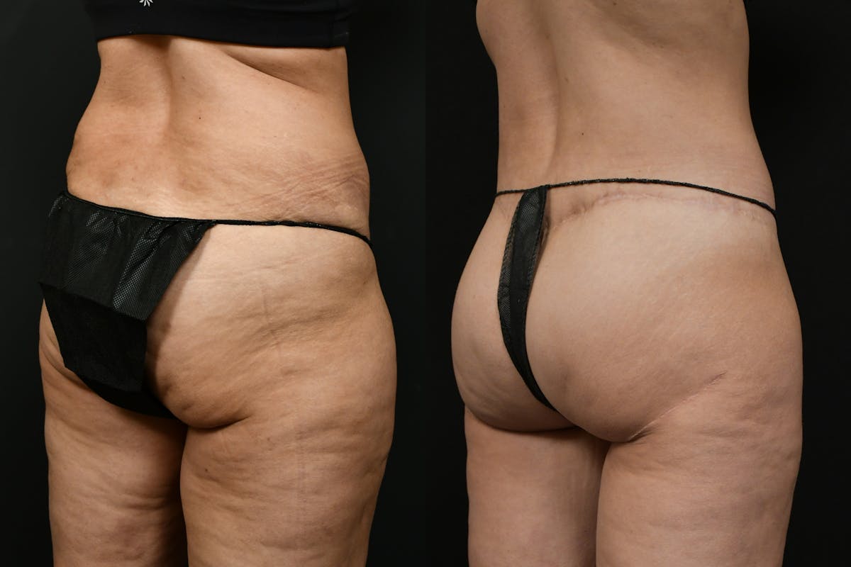 Butt Augmentation Before & After Gallery - Patient 251812 - Image 1