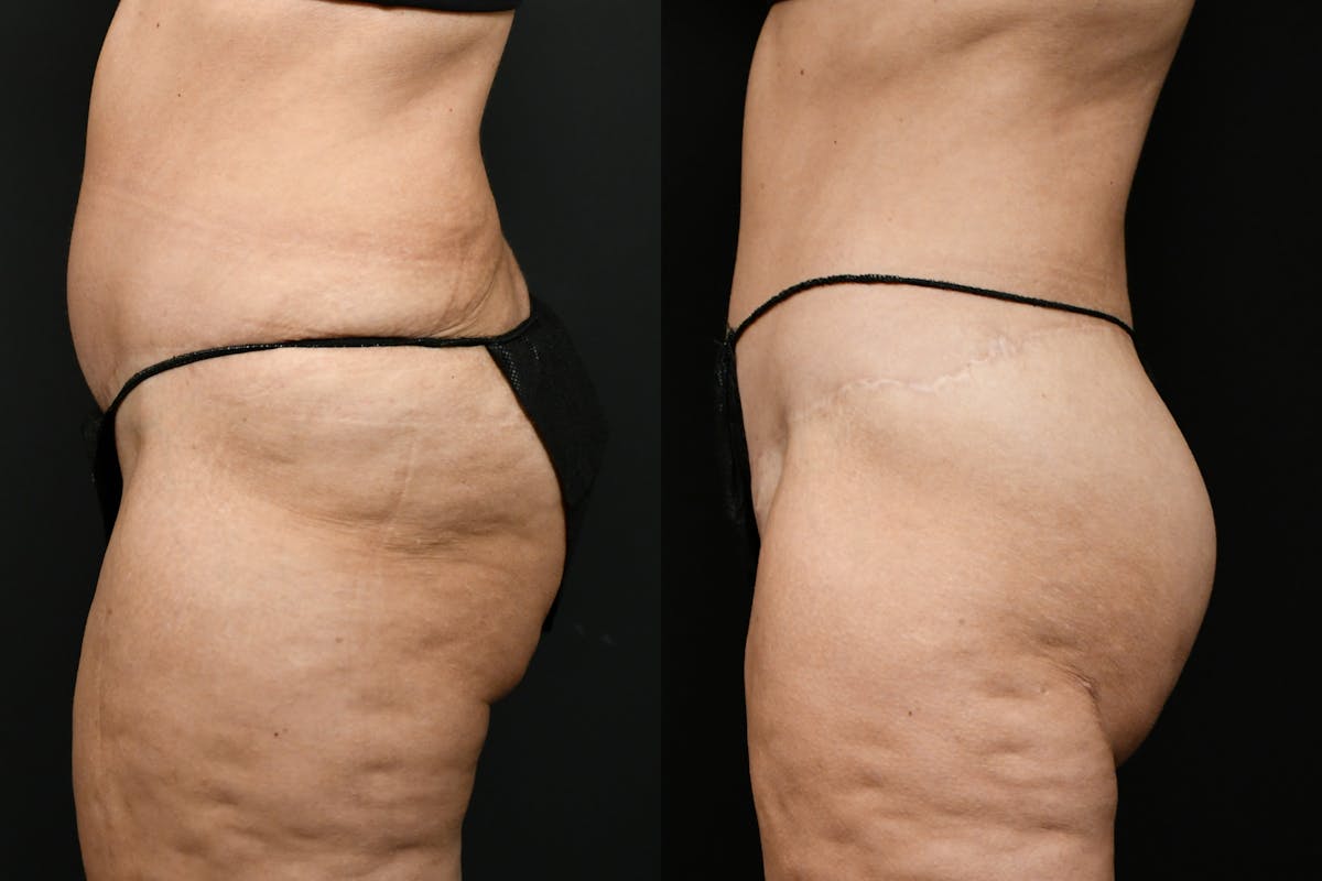 Butt Augmentation Before & After Gallery - Patient 251812 - Image 5