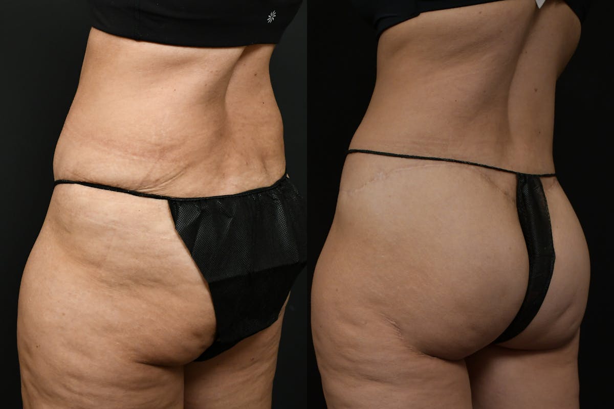 Butt Augmentation Before & After Gallery - Patient 251812 - Image 4