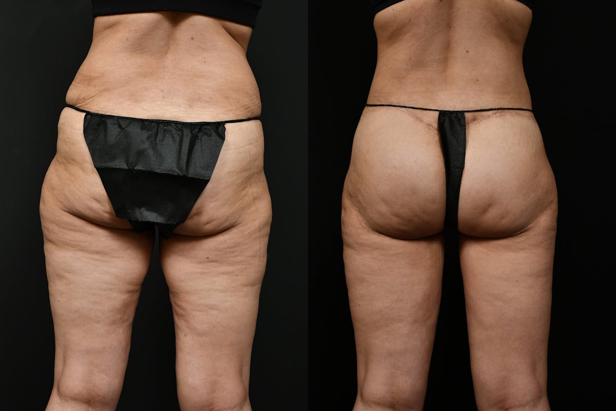 Butt Augmentation Before & After Gallery - Patient 251812 - Image 6