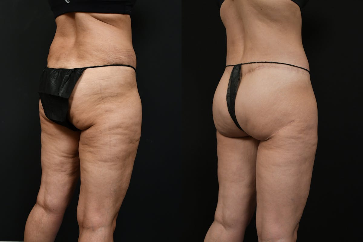 Butt Augmentation Before & After Gallery - Patient 251812 - Image 2