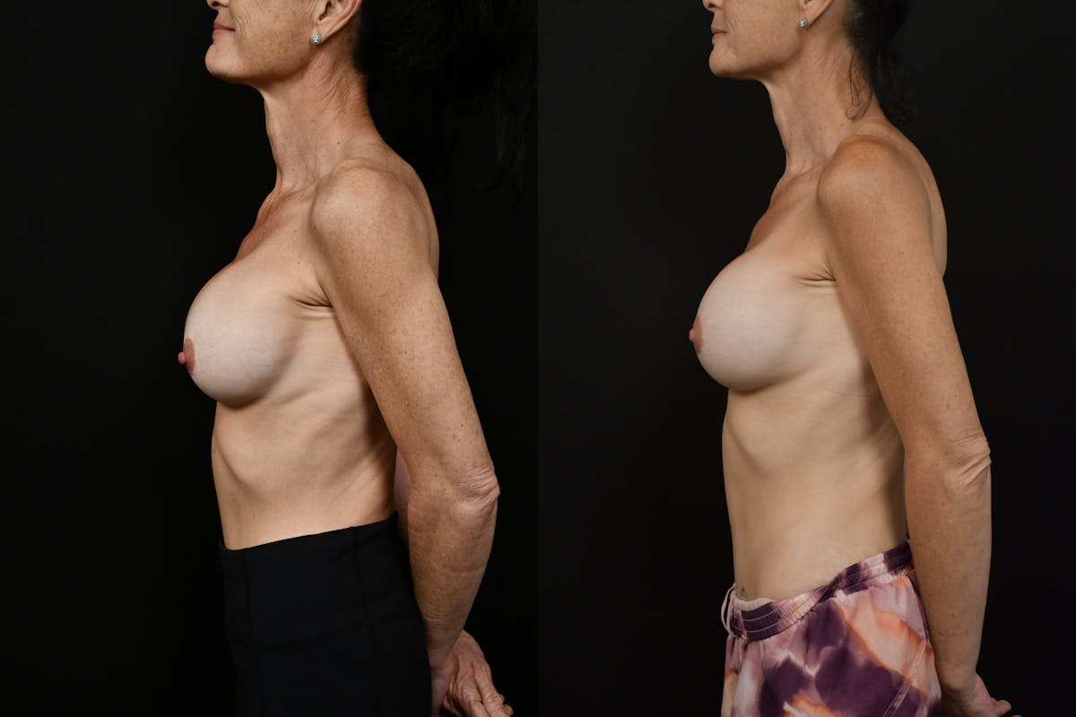 Breast Revision Before & After Gallery - Patient 266550 - Image 5