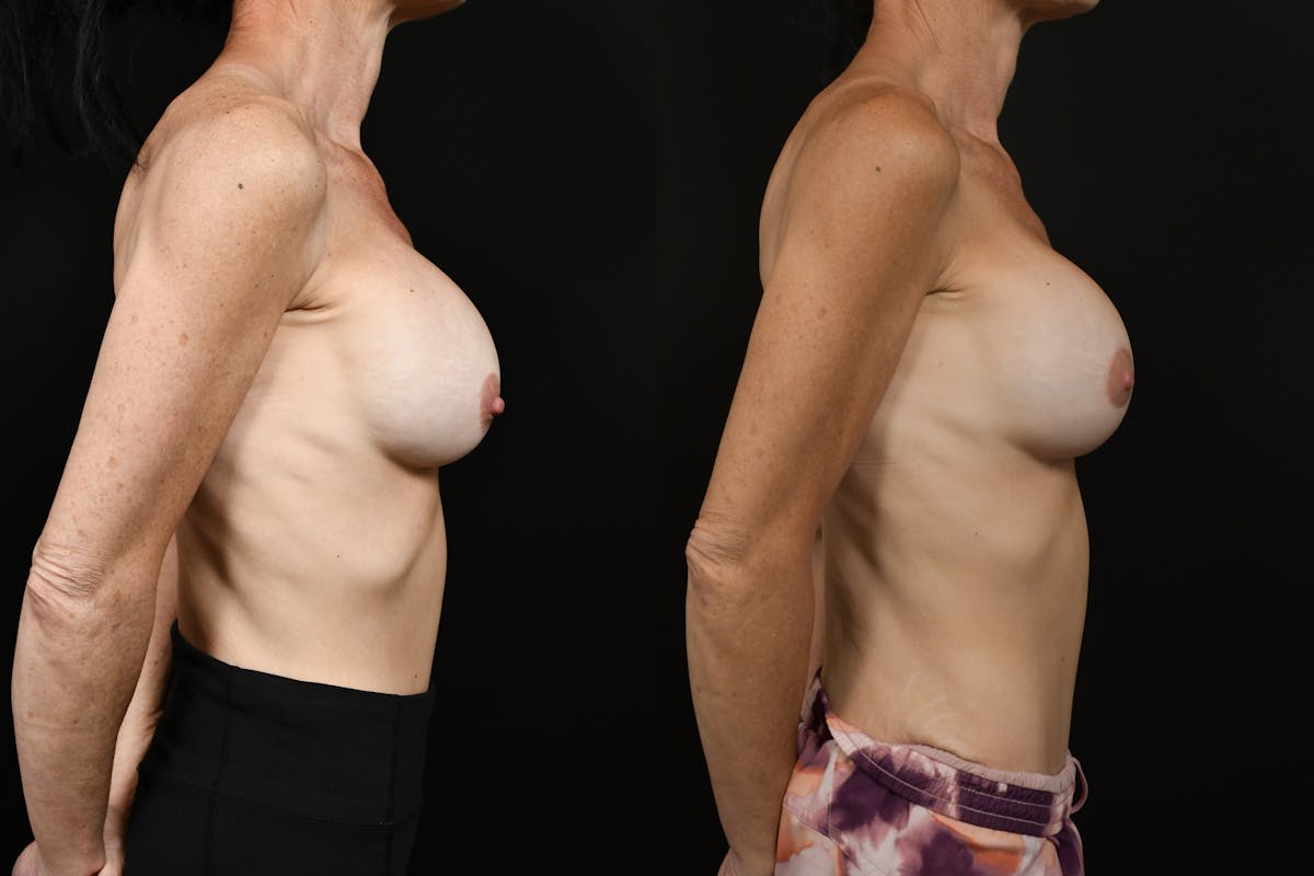 Breast Revision Before & After Gallery - Patient 266550 - Image 3