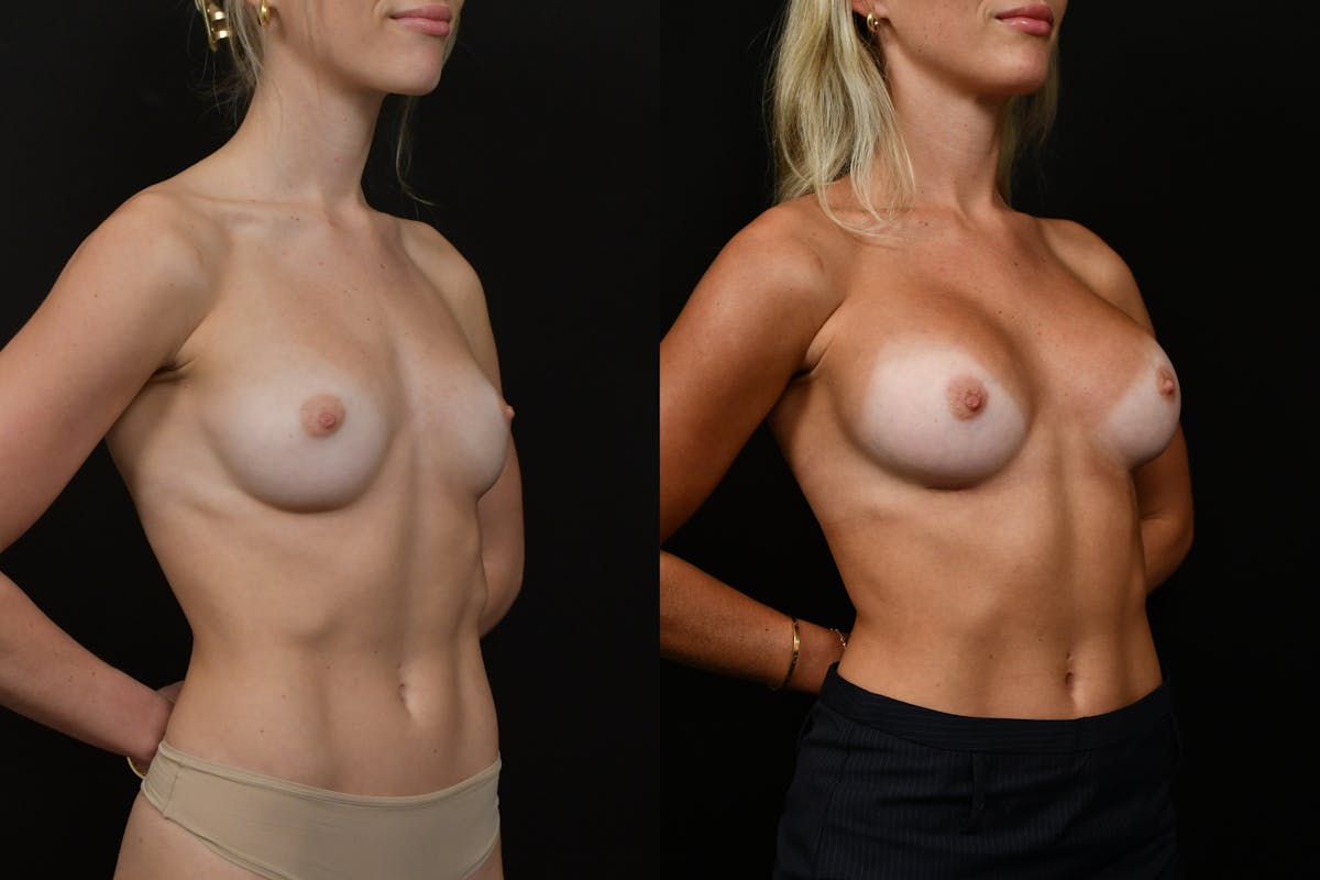 Breast Augmentation Before & After Gallery - Patient 142435 - Image 2