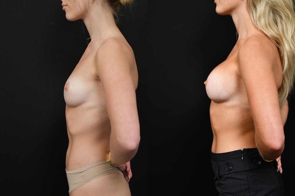 Breast Augmentation Before & After Gallery - Patient 142435 - Image 3