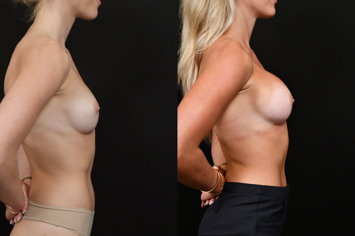Breast Augmentation Before & After Gallery - Patient 142435 - Image 5