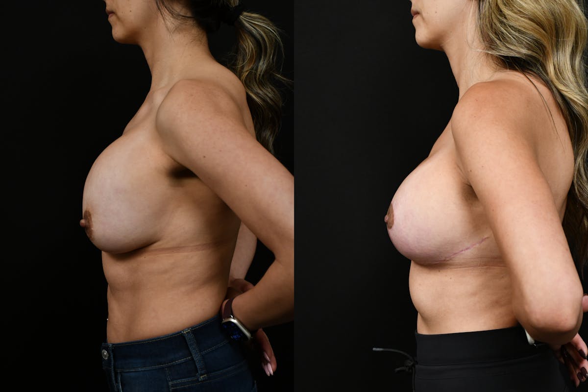 Breast Revision Before & After Gallery - Patient 278166 - Image 5