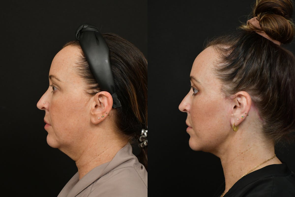 Eyelid Surgery Before & After Gallery - Patient 251258 - Image 5