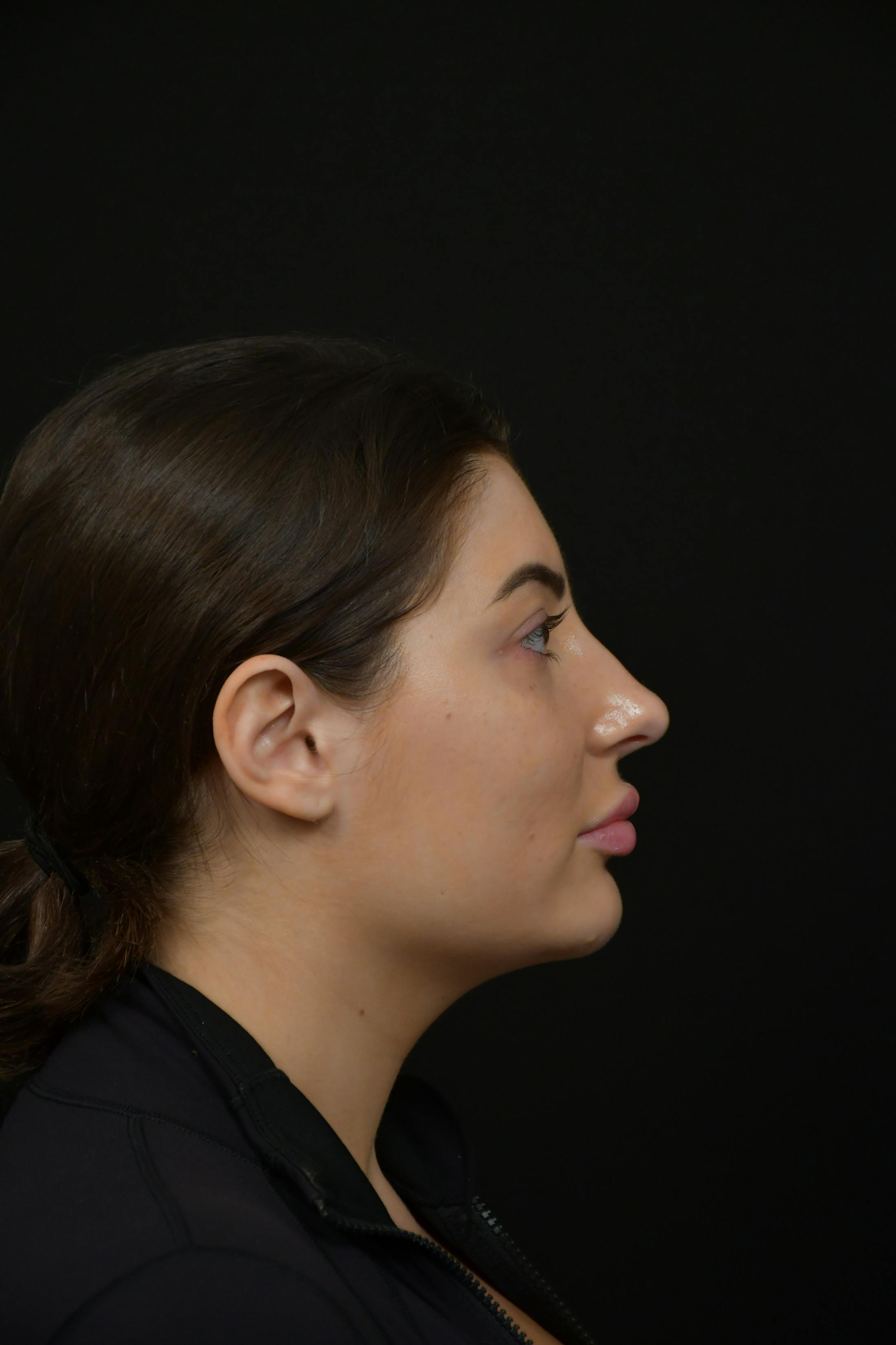 Injectables Before & After Gallery - Patient 933467 - Image 3