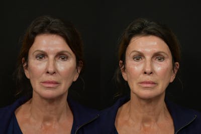 Injectables Before & After Gallery - Patient 311096 - Image 1