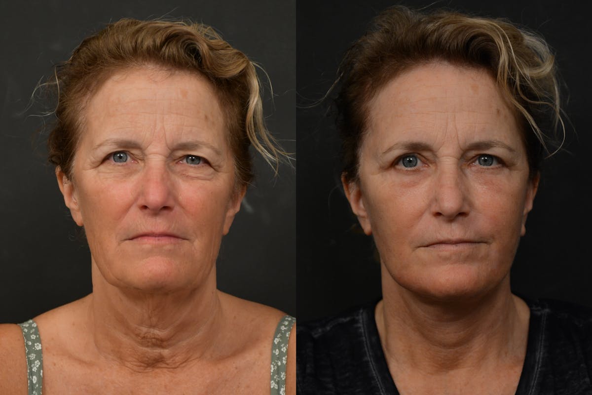 Changes Deep Plane Face Lift  Before & After Gallery - Patient 283471 - Image 5