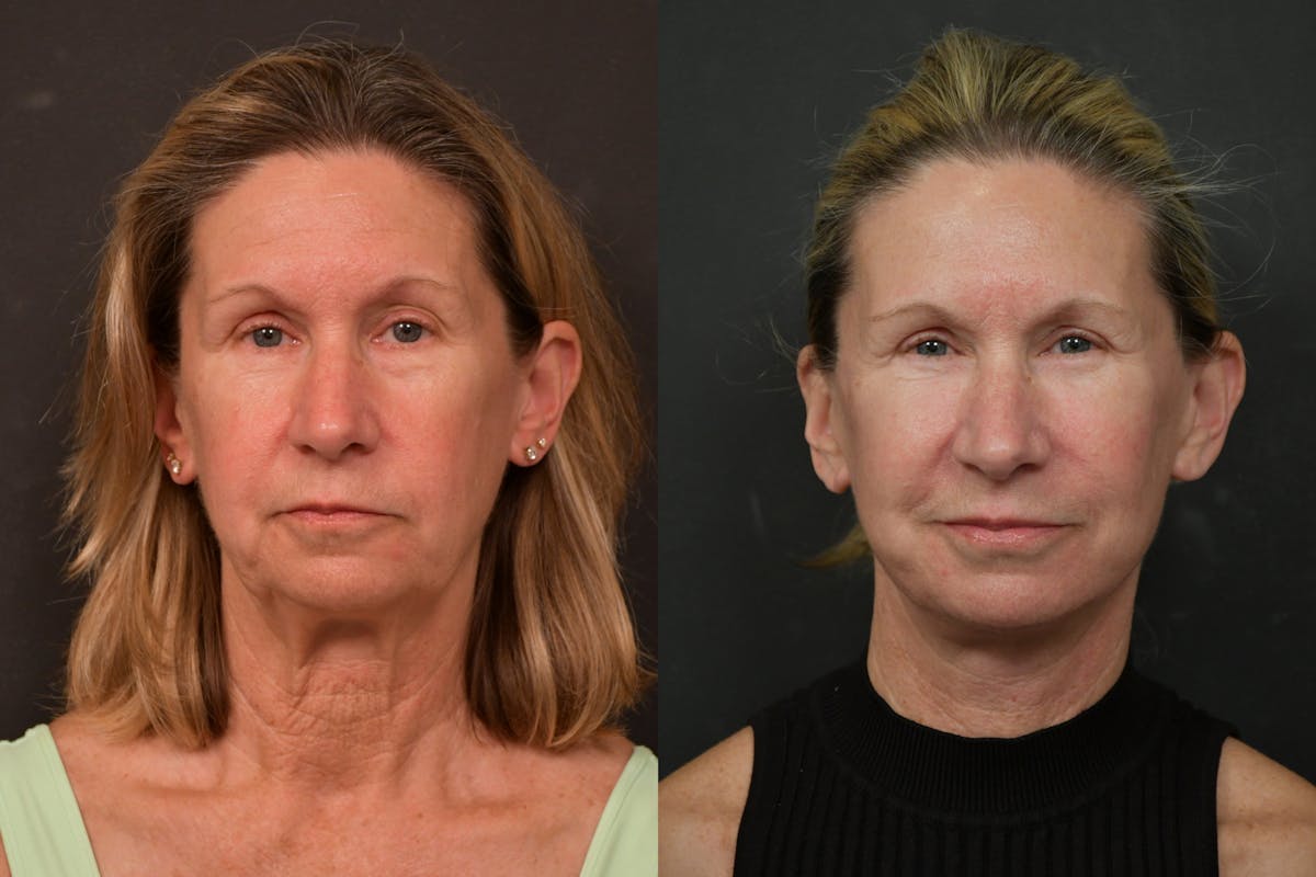 Changes Deep Plane Face Lift  Before & After Gallery - Patient 305415 - Image 5