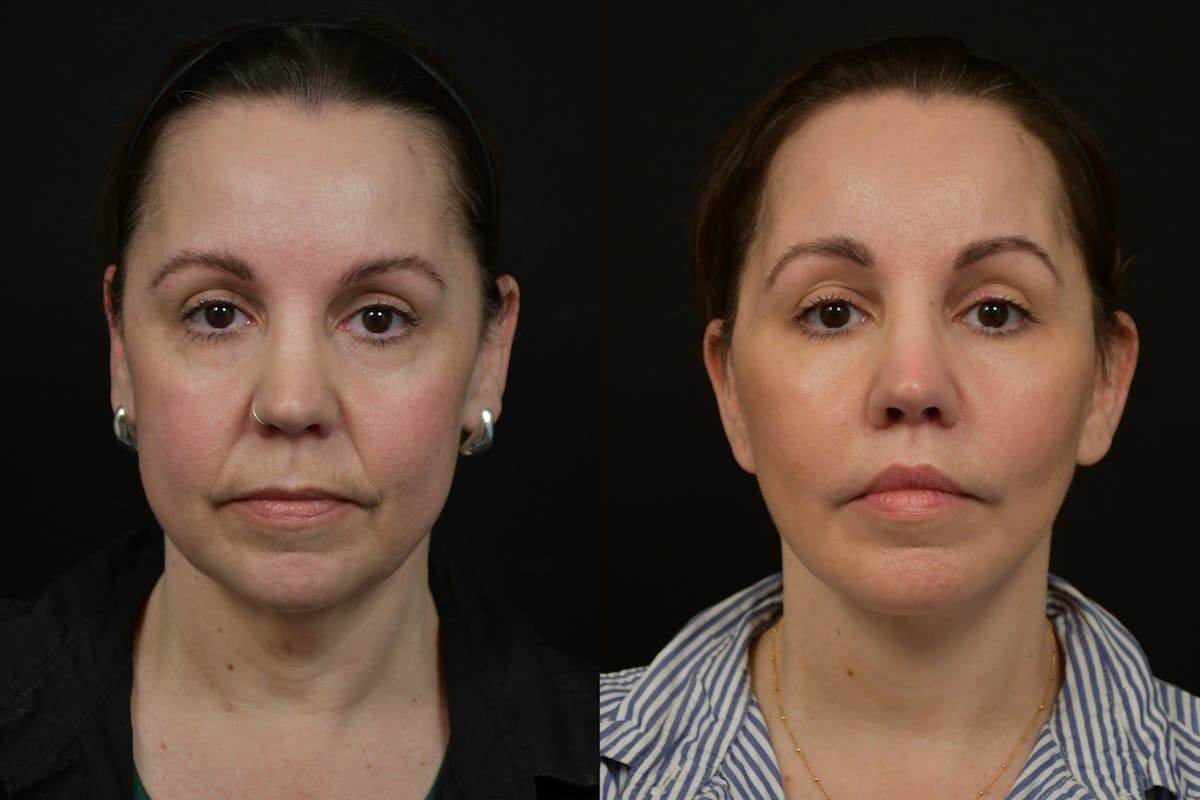 Changes Deep Plane Face Lift  Before & After Gallery - Patient 130363 - Image 5