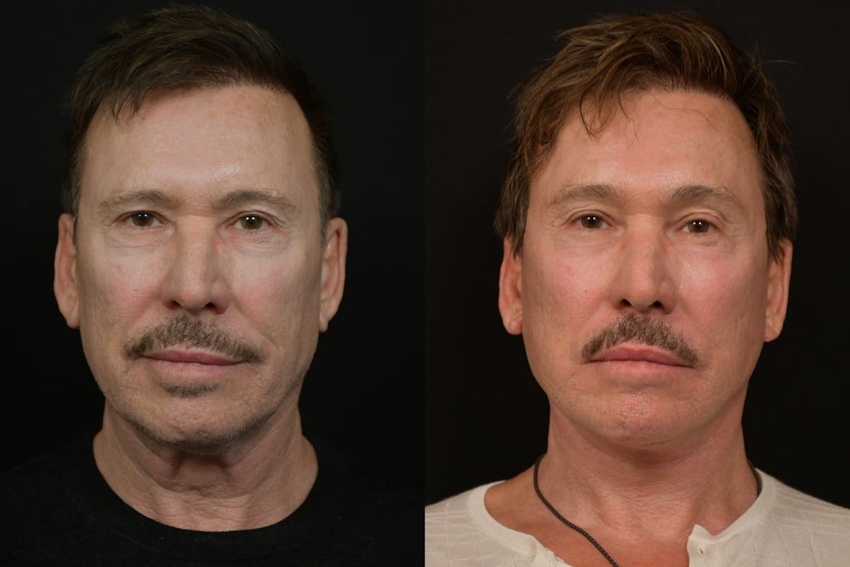Changes Deep Plane Face Lift Before & After Gallery - Patient 269113 - Image 5