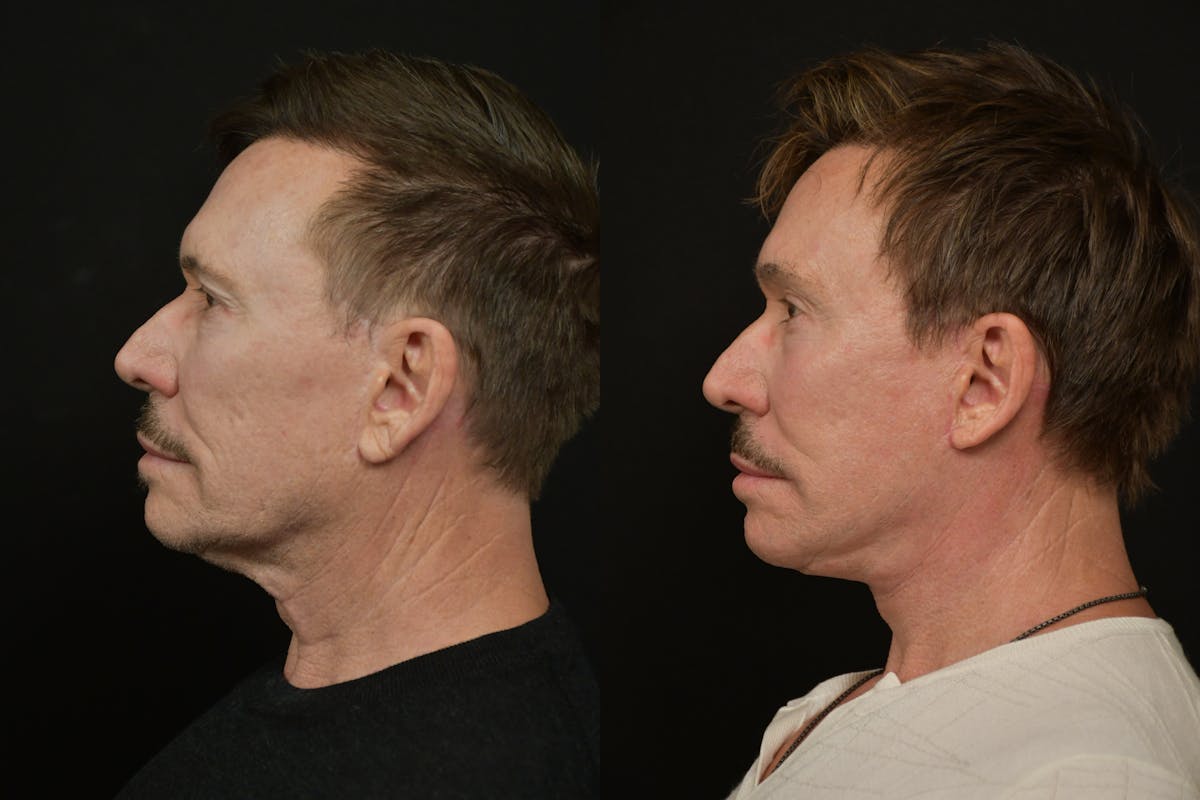 Changes Deep Plane Face Lift Before & After Gallery - Patient 269113 - Image 2
