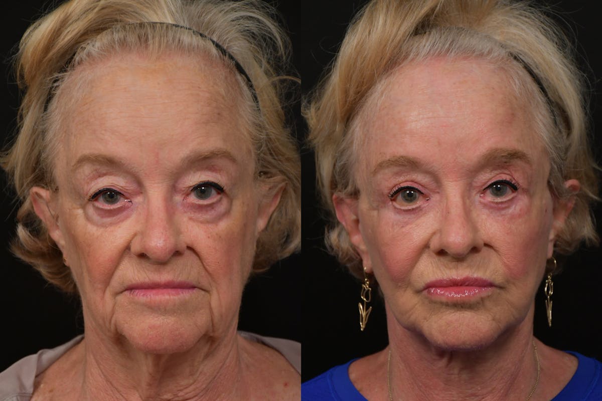 Neck Lift Before & After Gallery - Patient 313717 - Image 5