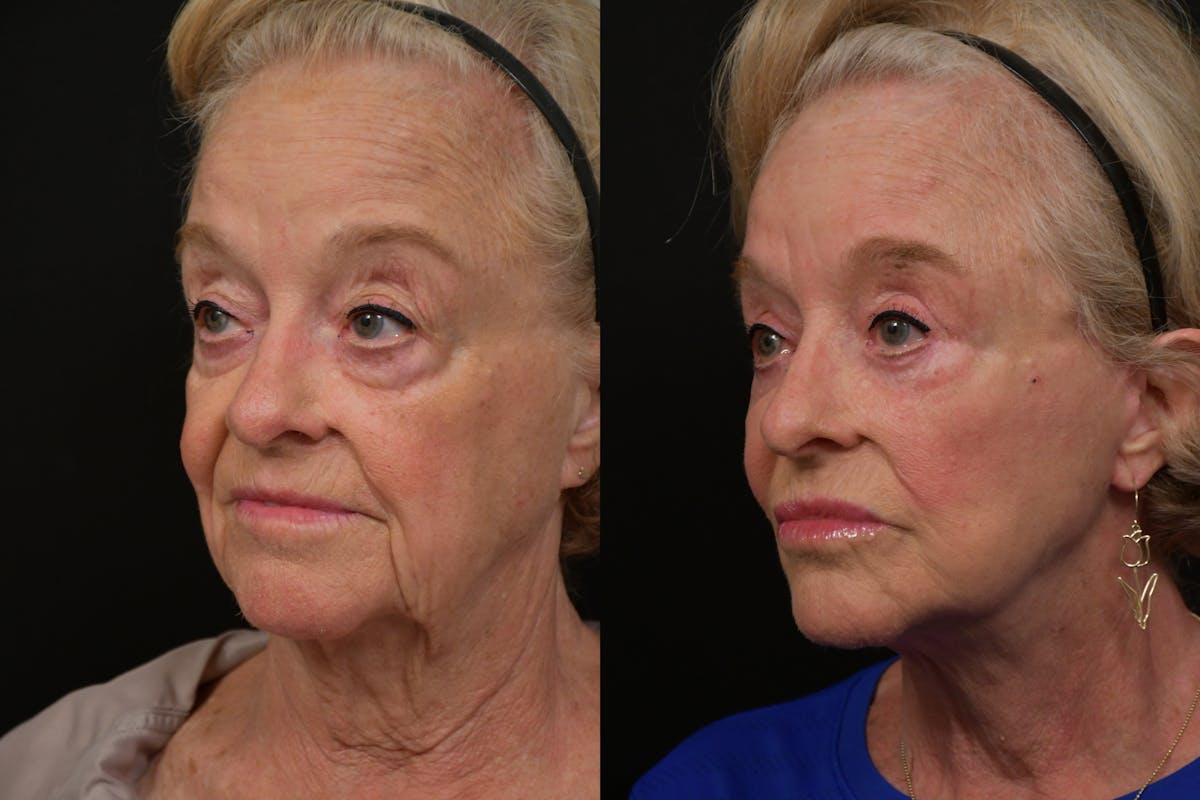 Neck Lift Before & After Gallery - Patient 313717 - Image 1