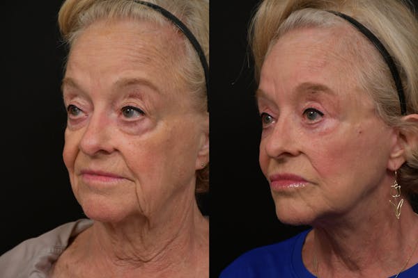 Neck Lift Before & After Gallery - Patient 313717 - Image 1