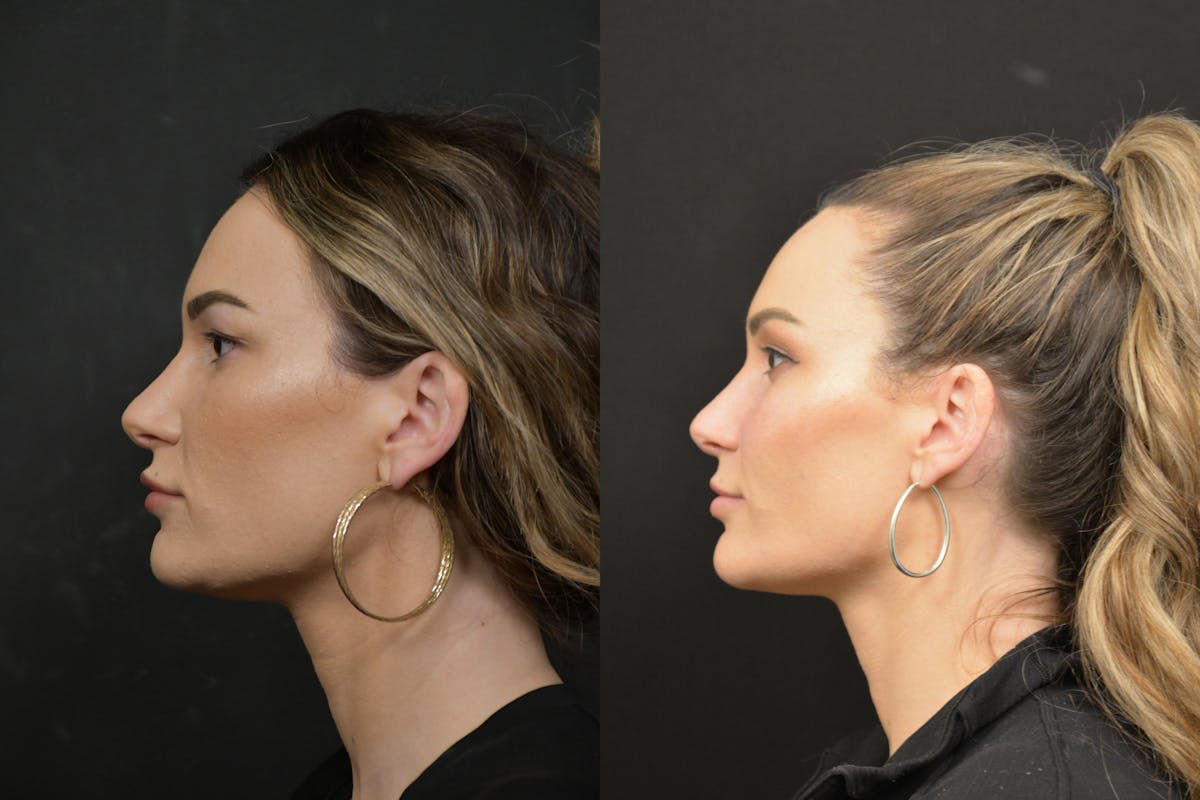 Eyelid Surgery Before & After Gallery - Patient 938526 - Image 5