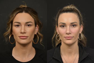 Injectables Before & After Gallery - Patient 807748 - Image 1