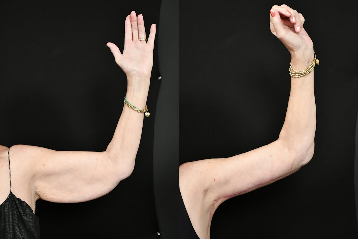 Arm Lift Before & After Gallery - Patient 277337 - Image 8