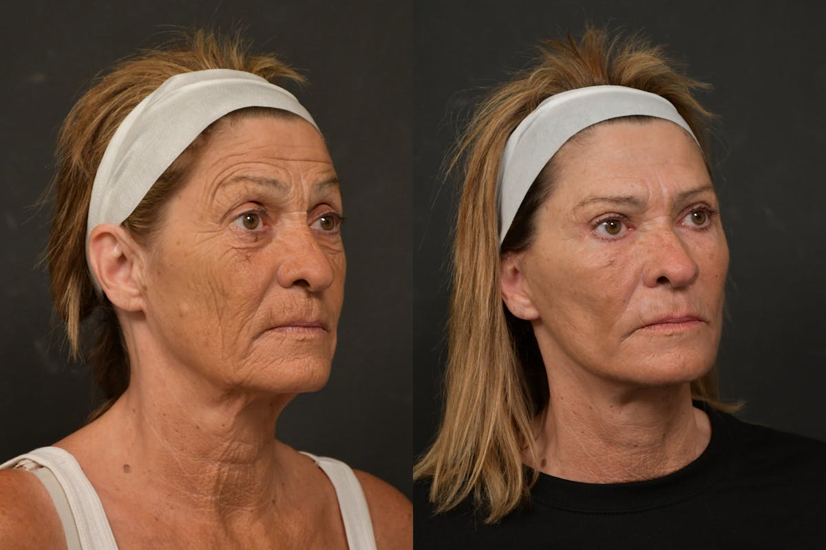 Changes Deep Plane Face Lift  Before & After Gallery - Patient 386471 - Image 3