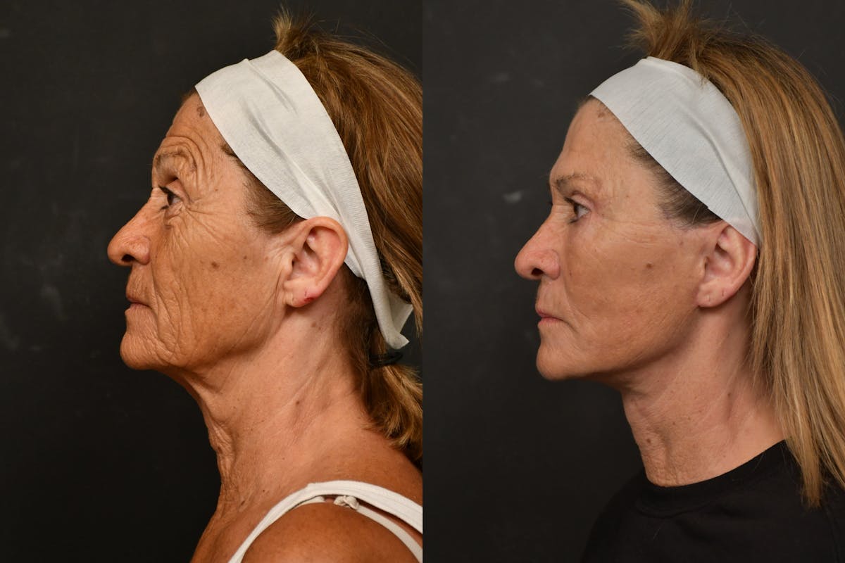 Changes Deep Plane Face Lift  Before & After Gallery - Patient 386471 - Image 2