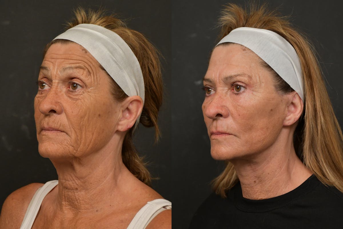 Changes Deep Plane Face Lift  Before & After Gallery - Patient 386471 - Image 1