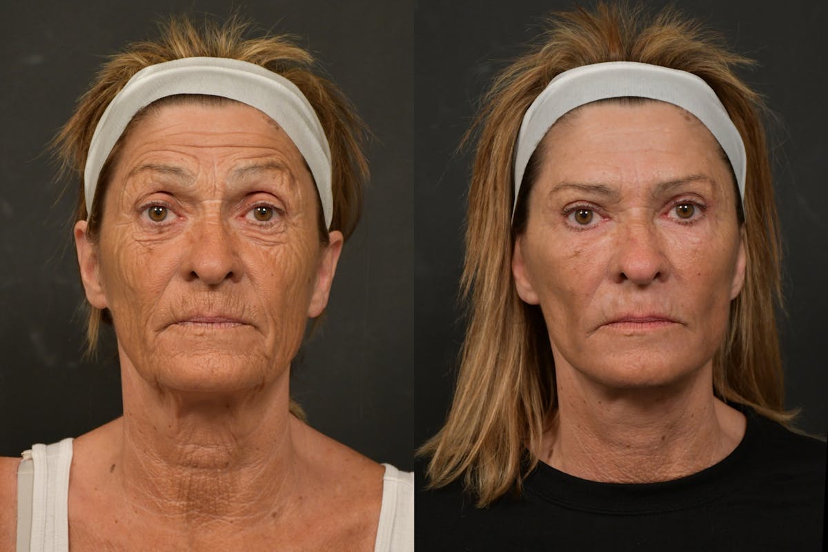 Changes Deep Plane Face Lift  Before & After Gallery - Patient 386471 - Image 5