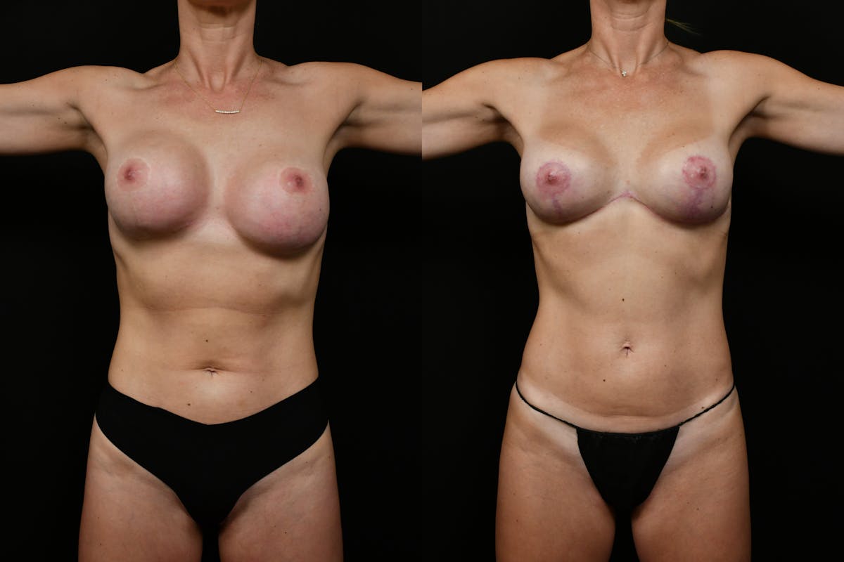 Reverse Tummy Tuck Before & After Gallery - Patient 224501 - Image 6
